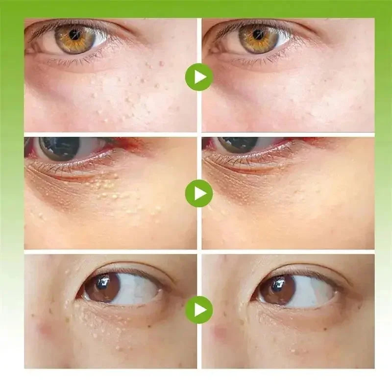 Fat Granules Remover Skin Care