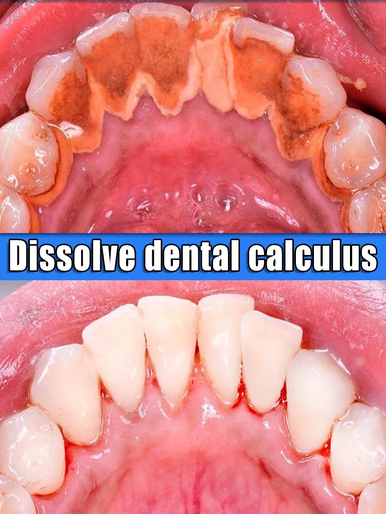 Toothpaste Whitening Tooth Remove  Stains